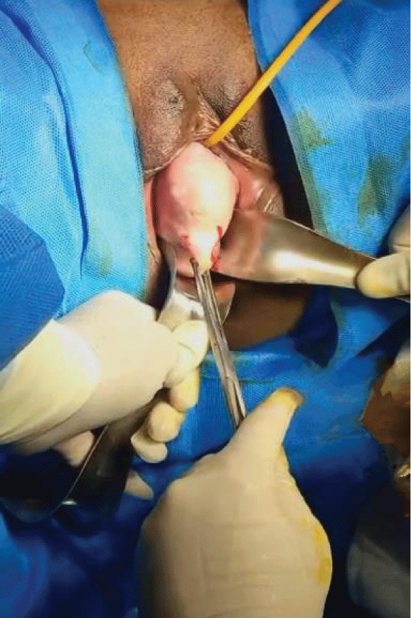 Anterior vaginal wall tumor.