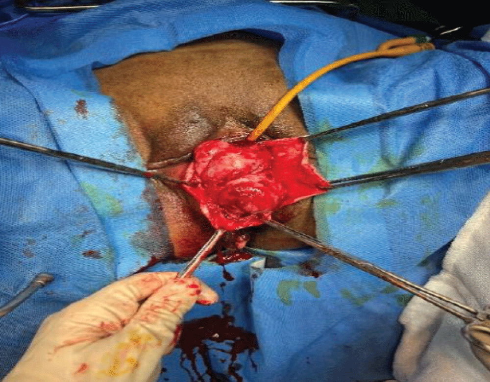 Intraoperative dissection of vaginal tumor.