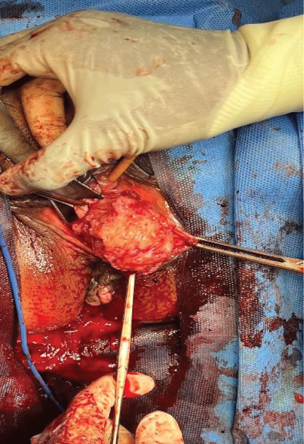 Intraoperative dissection of vulval tumor.