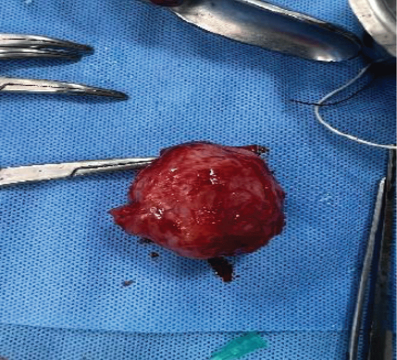 Vulval tumor with smooth external surface.