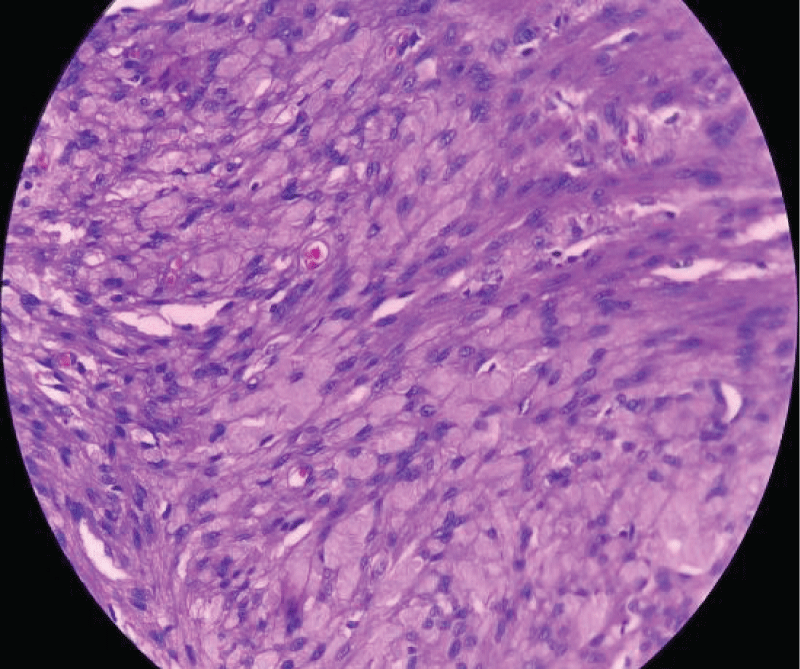 Sections show sheets and fascicles of spindle-shaped cells with focal mild nuclear Atypia with fibro-collagenous stroma, no necrosis, and mitoses < 5/10 HPF. (Magnification 400x).