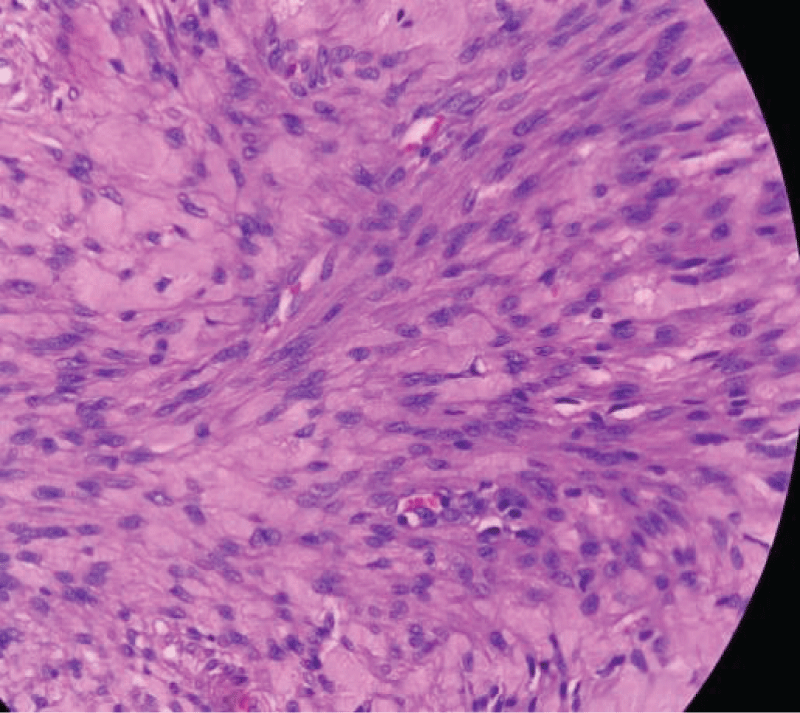 Sections show sheets and fascicles of spindle-shaped cells with focal mild nuclear Atypia with fibro-collagenous stroma, no necrosis, and mitoses < 5/10 HPF. (Magnification 400x).