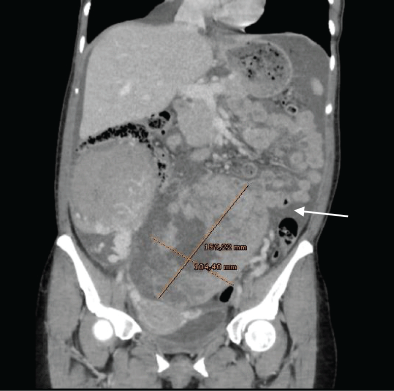 Ascitic fluid suggestive of peritoneal carcinomatosis (→). Large, vascularized, and heterogeneous masses that depended on both ovaries, the one on the left side measured up to 16 x 10 cm.