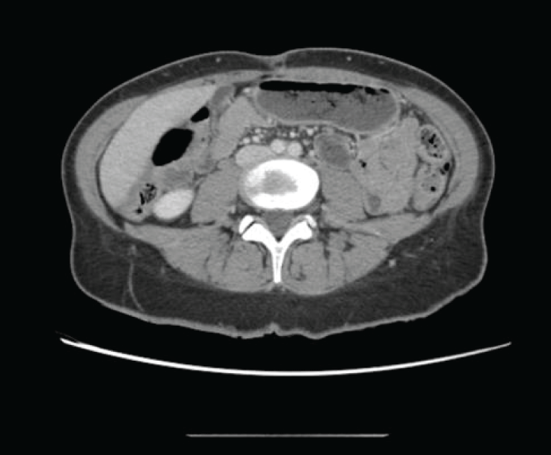 Subtly granular appearance of the peritoneal fat, which does not allow to conclusively rule out metastatic carcinomatous dissemination.